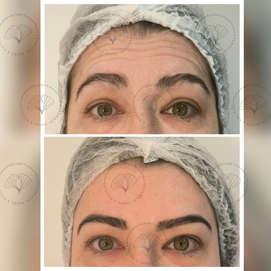 Toxina Botulínica — Clínica Blumet
