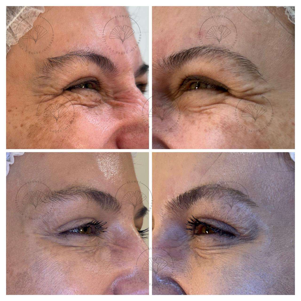 Toxina Botulínica — Clínica Blumet