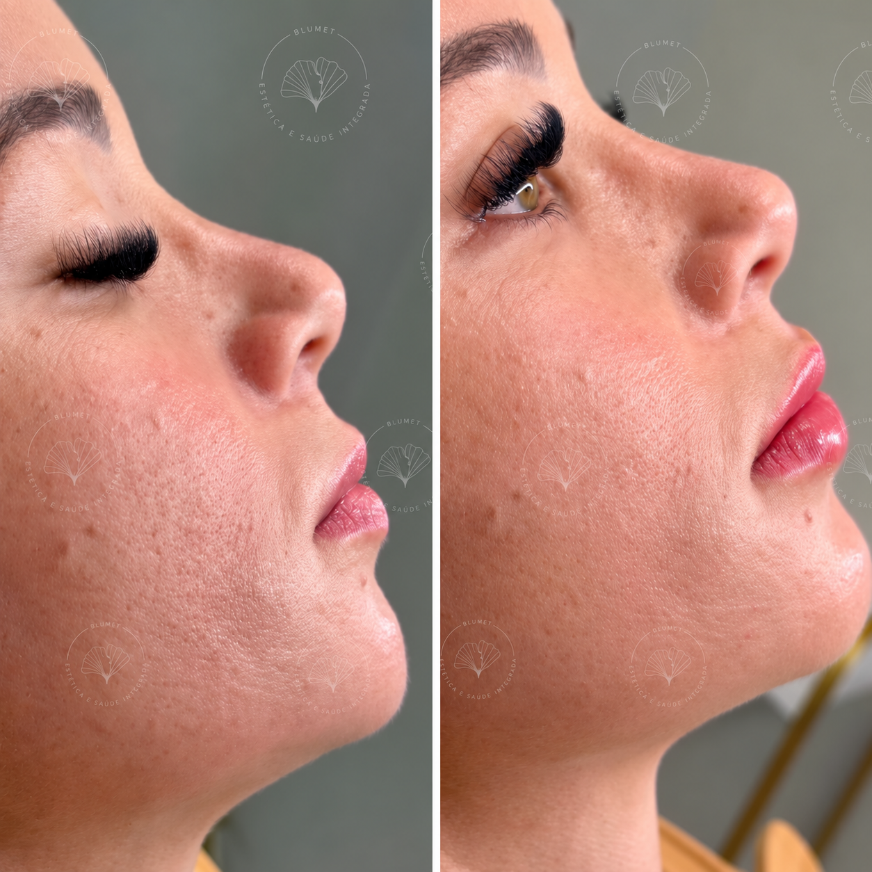 Harmonização Facial — Clínica Blumet