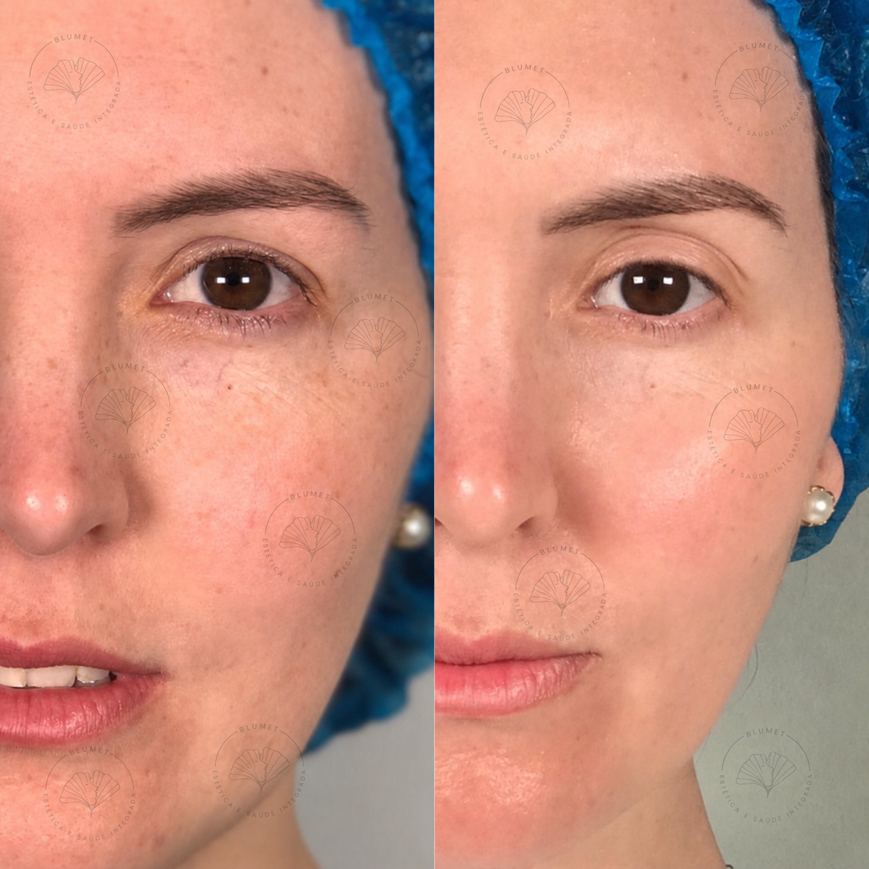 Peeling Químico — Clínica Blumet