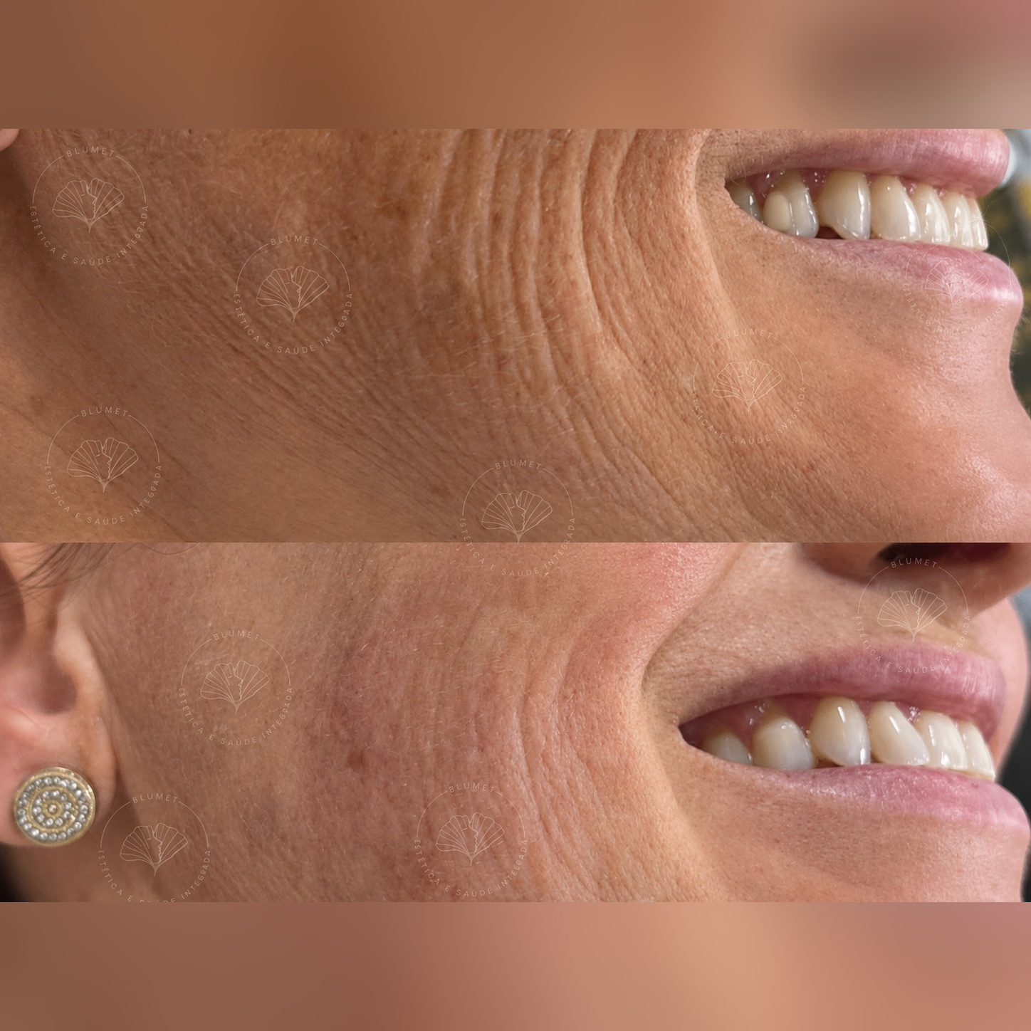 Ultrassom Microfocado HIFU — Clínica Blumet